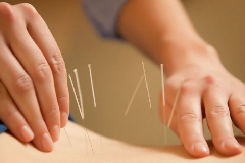 Pachet 3 sedinte acupunctura - Consultatie 180 lei!