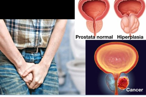 Ecografie de prostata transabdominala