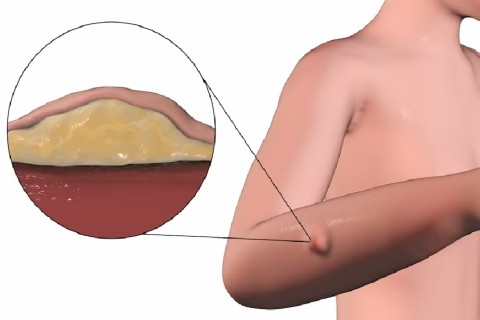 Pachet chirurgie generala - excizie lipom (consult initial, ex. histopatologic, excizie, controale)