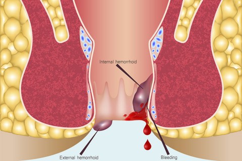 Pachet chirurgie generala - tratament hemoroizi (consult initial, procedura, controale, analize)