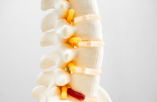 Explorând cauzele și factorii de risc în apariția herniei de disc: ce trebuie să ții cont